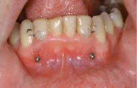 Utilizarea microimplantului în ortodonție