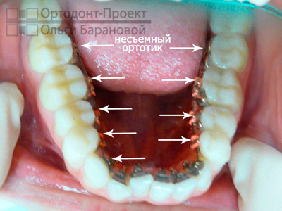 Виправлення глибокого прикусу