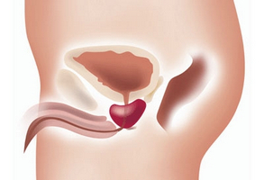 Ce tratamente pentru adenomul prostatic sunt folosite astăzi?