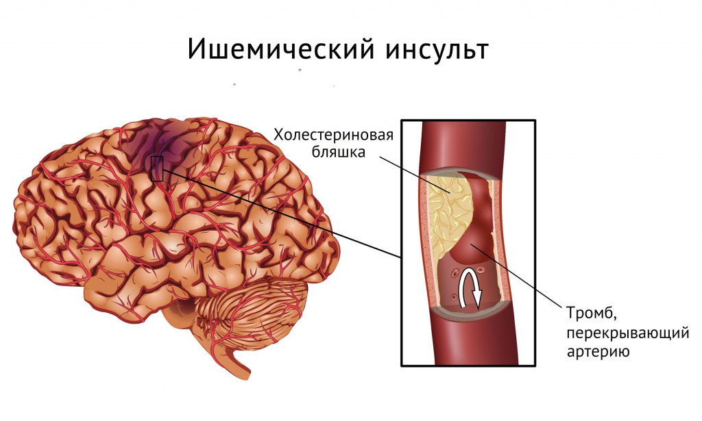 Cum să evitați tratamentul accident vascular cerebral