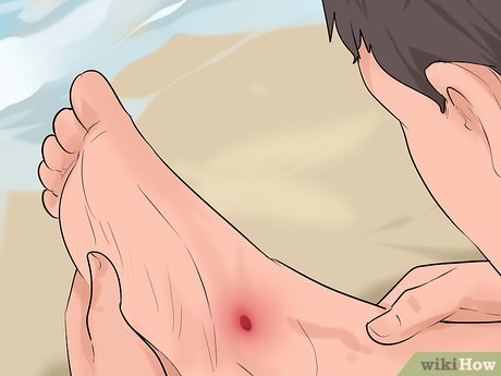 Як розпізнавати і лікувати рани від уколу ската або морського їжака