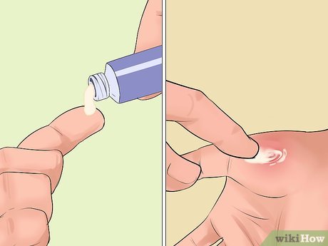 Cum să recunoaștem și să tratăm rănile de la o injectare de urzică sau de mătură