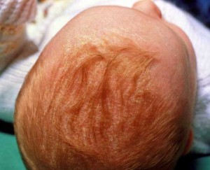 Як прибрати корочку на голові у новонародженої дитини