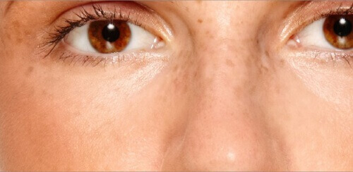 Як зменшити пігментні плями на обличчі і позбутися від них