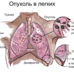 Як помирають від раку легенів нелегка смерть хворих