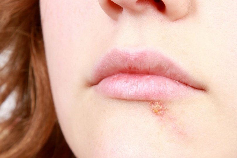 Cum arată herpesul pe buze simptome, foto