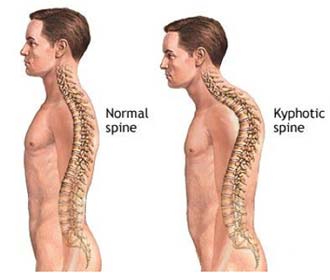 Cifoza coloanei vertebrale toracice - cauze, simptome, tratament, diagnosticul de kyfoză