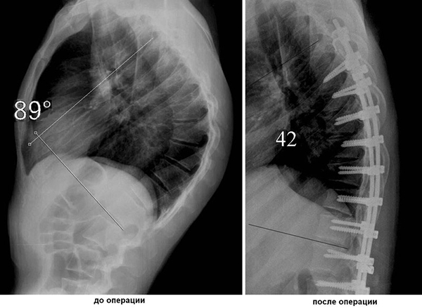 Cifoza fotografiei și tratamentului coloanei vertebrale toracice, cervicale și lombare