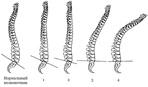 Кіфоз грудного, шийного і поперекового відділів хребта фото і лікування