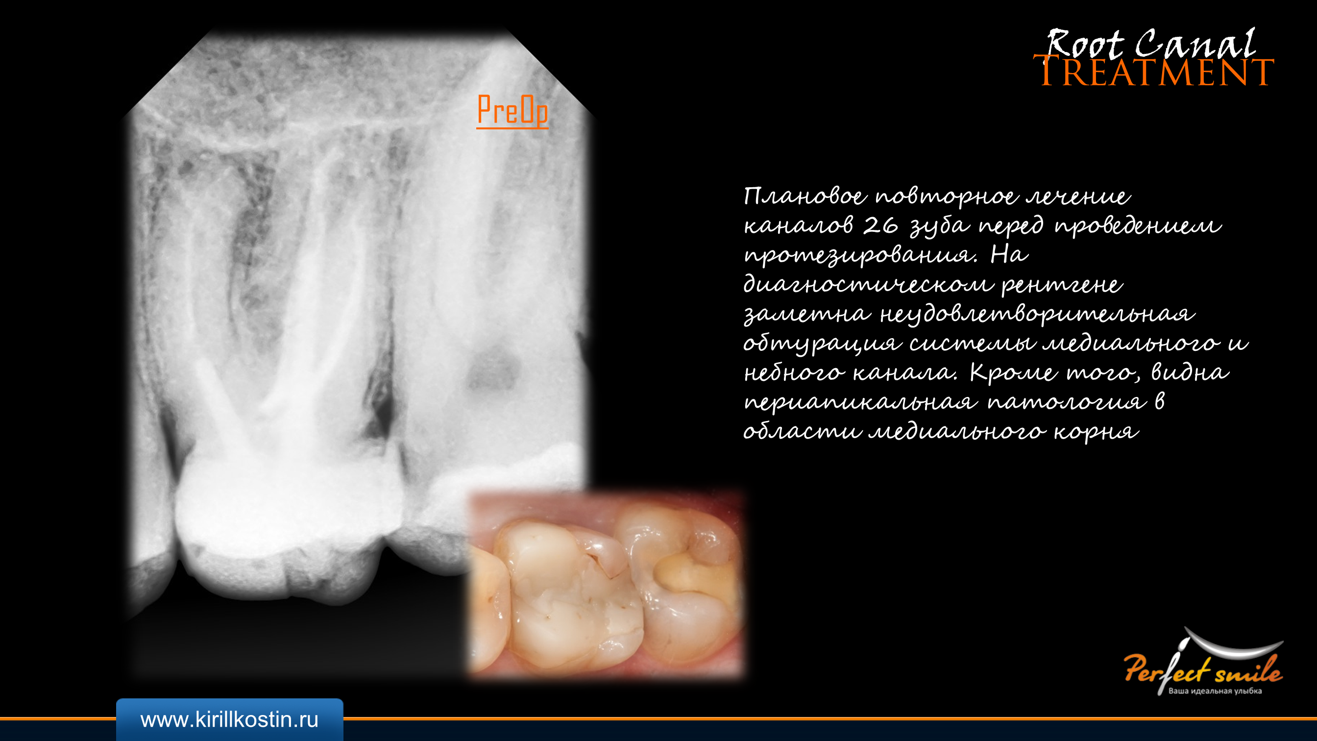 Caz clinic de re-tratament a canalelor radiculare ale dinților 2