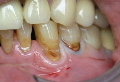 Cauzele defectului dintelui Cuneoid și metodele de tratament
