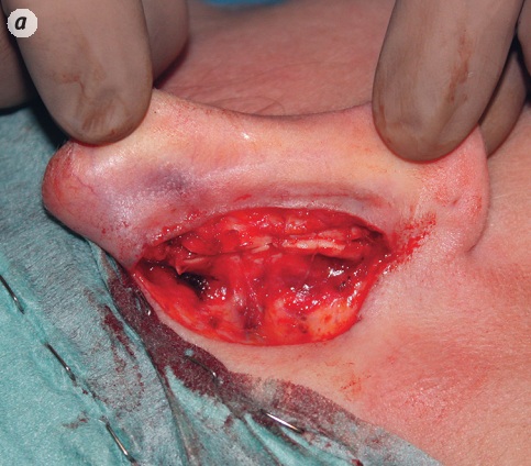 Când și cum se face transplantul de cartilaj în rinoplastie