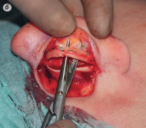 Când și cum se face transplantul de cartilaj în rinoplastie