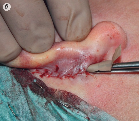 Când și cum se face transplantul de cartilaj în rinoplastie