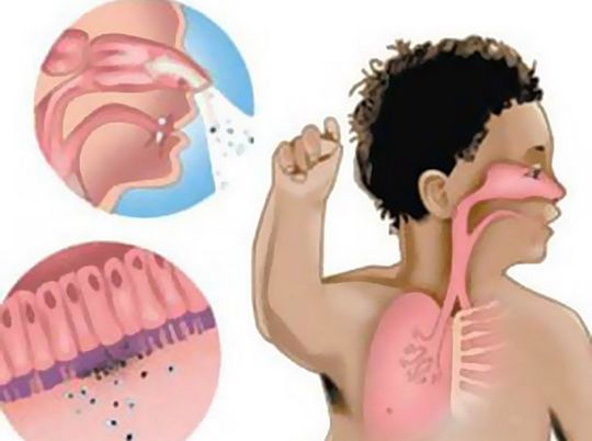 Pertussis la copii - cauze, simptome și regim de tratament