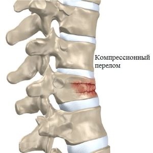 Fractura de compresie a coloanei vertebrale la copiii cu simptome, tratament, reabilitare și consecințe