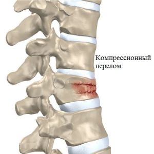 Компресійний перелом хребта у дітей симптоми, лікування, реабілітація та наслідки