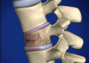 Fractura de compresie a coloanei vertebrale la copiii cu simptome, tratament, reabilitare și consecințe