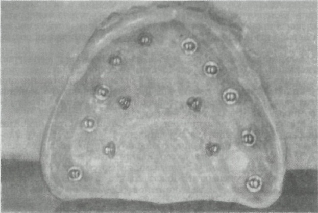 Structurile implantului - stomatologie ortopedică, tratamentul adenelor folosind implanturi