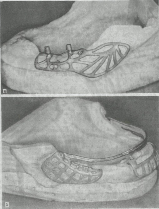 Structurile implantului - stomatologie ortopedică, tratamentul adenelor cu ajutorul implanturilor