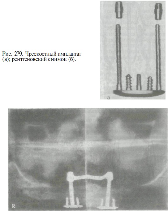 Structurile implantului - stomatologie ortopedică, tratamentul adenelor folosind implanturi