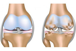 Лікування артрозу колінного суглоба 2 ступеня, стадії артрозу