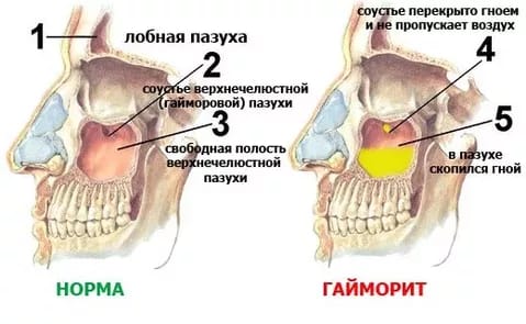 Tratamentul sinuzitei cu medicamente populare cele mai eficiente comentarii