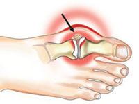 Лікування подагри в домашніх умовах можливо воно