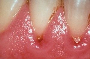 Лікування пульпіту молочних зубів у дітей, періодонтит у дитини