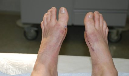 Tratamentul deformării valgusului piciorului cu laser