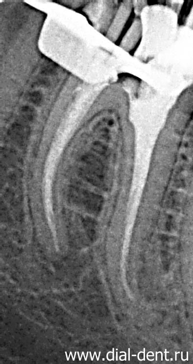 Tratamentul stomatologic cu microscop