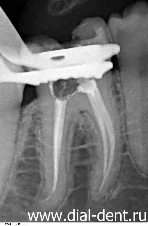 Tratamentul stomatologic cu microscop