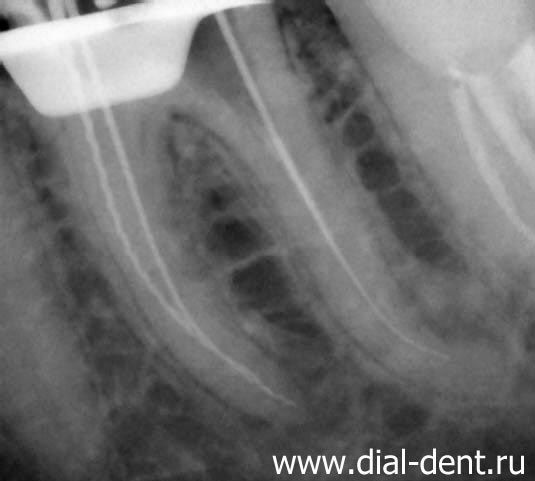 Tratamentul stomatologic cu microscop