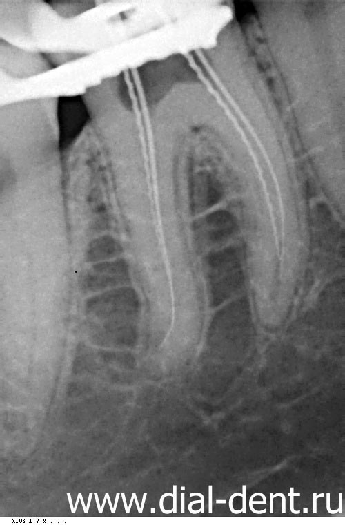 Tratamentul stomatologic cu microscop