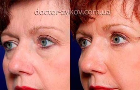 Ліпофілінг очей що це, фото до і після