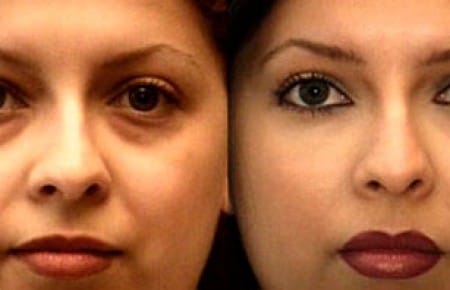 Lipofilling szem azaz előtti és utáni képek