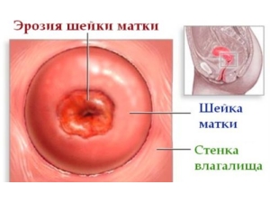 Unguentul de la Vișevski (aplicație în ginecologie)