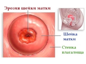 Мазь Вишневського (застосування в гінекології)