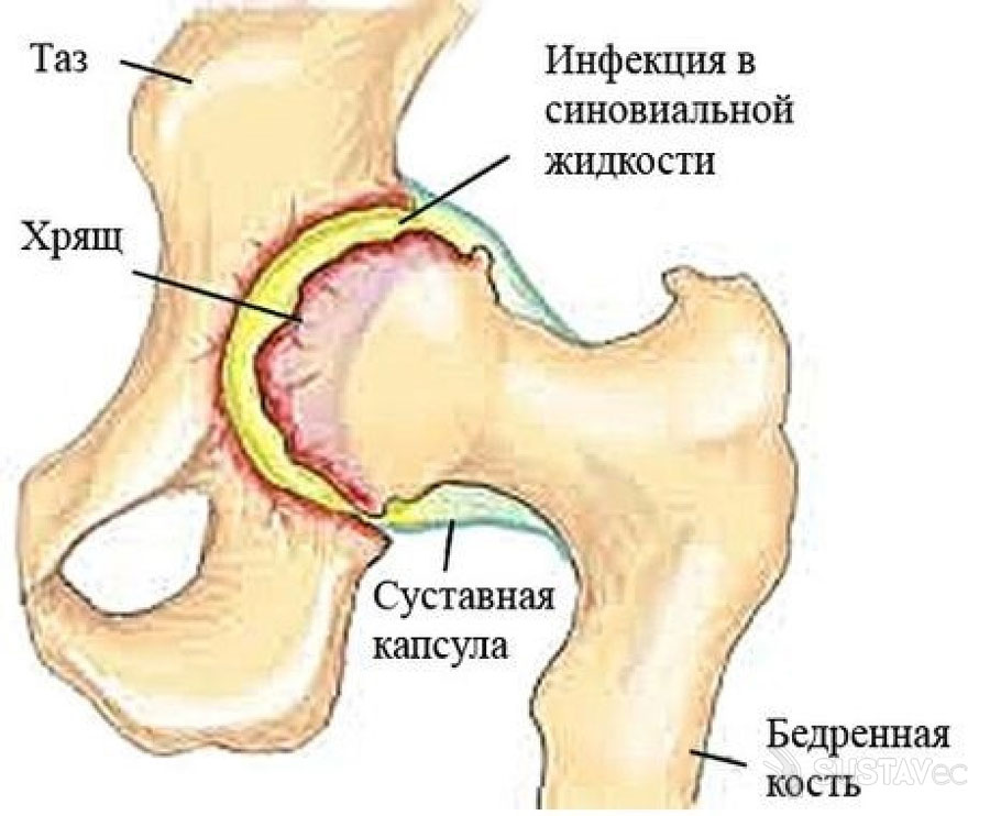 Медична жовч при артрозі колінного суглоба компрес мед жовчю