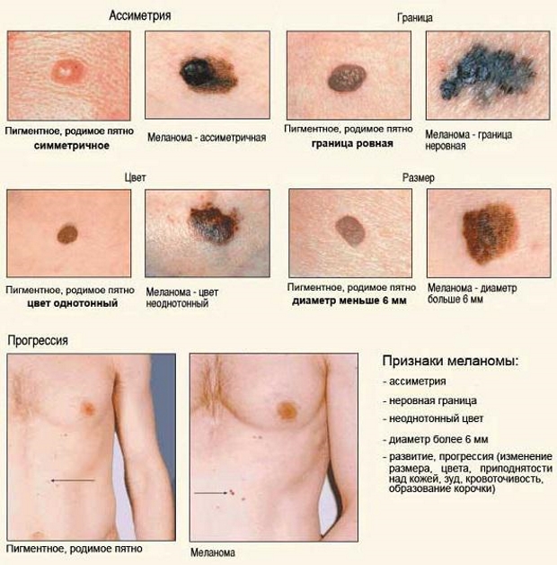 Меланома шкіри прогнози життя, симптоми