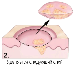 Меланома - хірургічне лікування