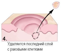 Меланома - хірургічне лікування