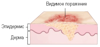 Меланомът - хирургия