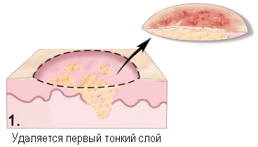 Меланома - хірургічне лікування