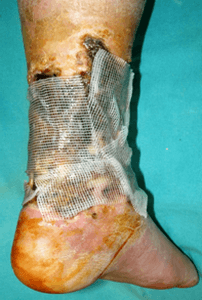 Tratamentul local al rănilor purulente - bandaje, unguente, antiseptice