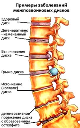 Методи лікування остеохондрозу хребта