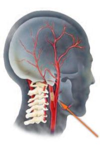 Încălcarea fluxului venos la osteochondroza cervicală