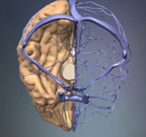 Încălcarea fluxului venos la osteochondroza cervicală