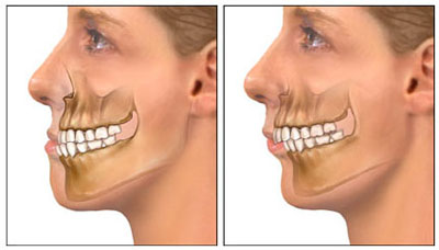 Subdezvoltarea maxilarului inferior cauzează tratament