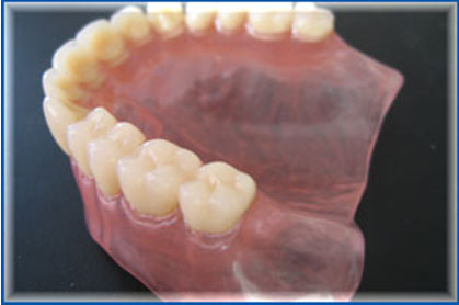 Protezele dentare detașabile din nylon - deficiențe și avantaje ale protezelor din nylon, private